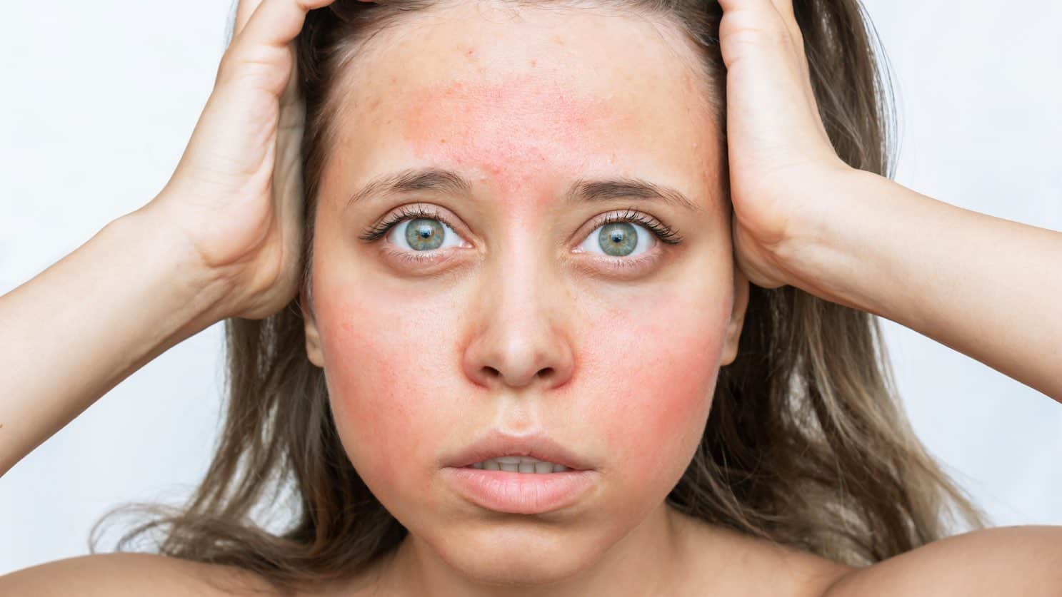 5 Cara Mengetahui Alergi Kosmetik pada Kulit